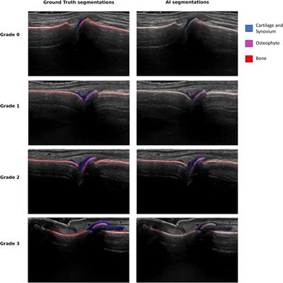 Artificial intelligence model for segmentation and severity scoring of osteophytes in hand osteoarthritis on ultrasound images